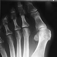11841-21-hallux-valgus.jpg?size=1024&now